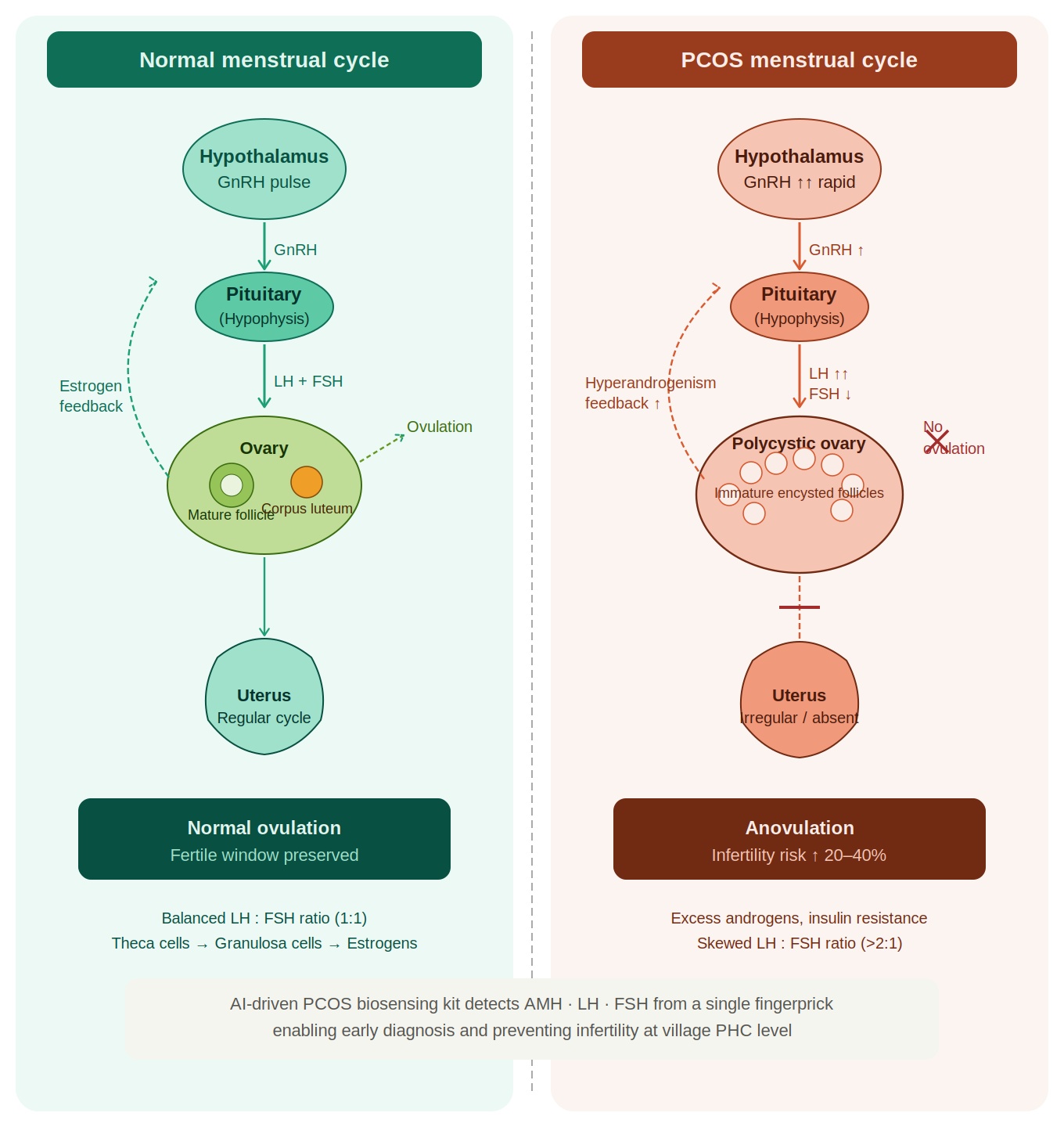 Side-by-side diagram of the normal menstrual cycle versus the PCOS cycle along the hypothalamus–pituitary–ovary axis.